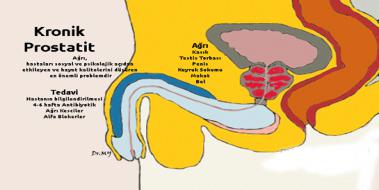 Kronik Prostat ltihab