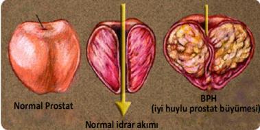 Prostat Hacmi