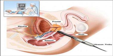 Prostat Hipertrofisi