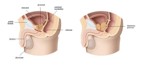 Prostat Ars